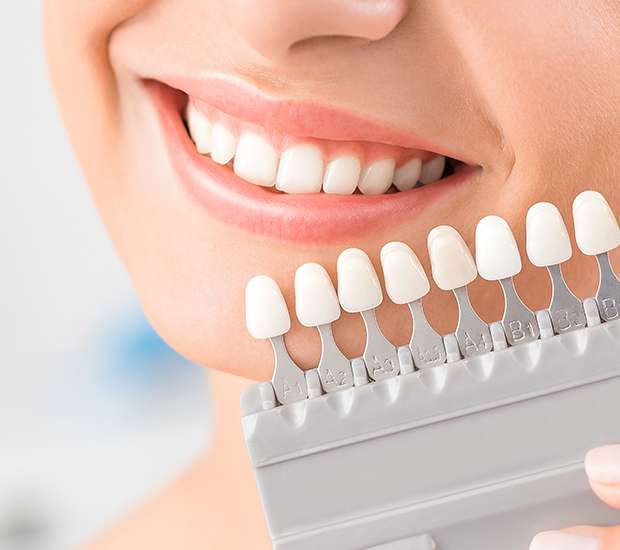 Carlsbad Dental Veneers and Dental Laminates