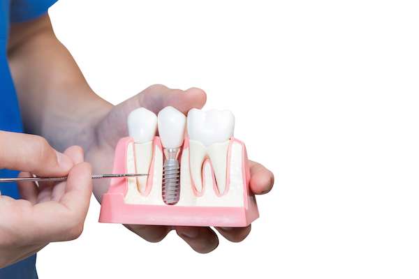 Can You Get Dental Implants if You Have Gum Disease from Ida Alfonso, DMD in Carlsbad, CA
