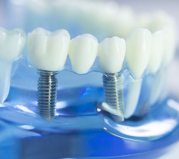 Carlsbad Dental Implants