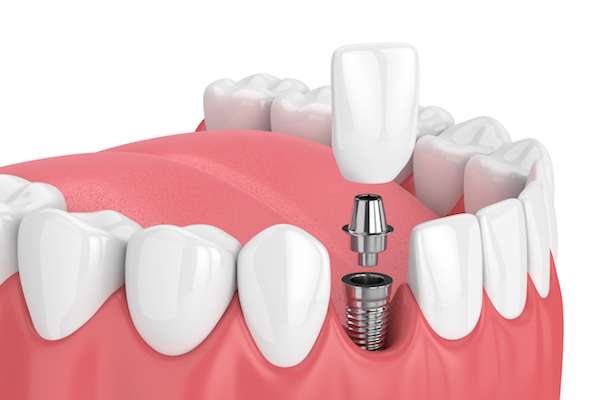 How Painful is Dental Implant Surgery from Ida Alfonso, DMD in Carlsbad, CA