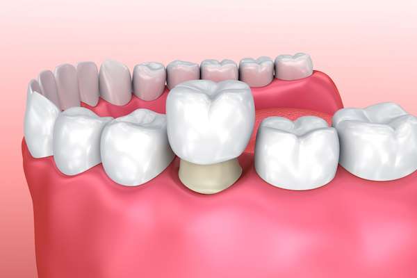 Permanent Dental Crowns vs. Temporary: Is There a Difference from Ida Alfonso, DMD in Carlsbad, CA
