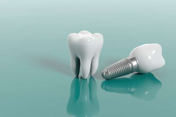 Questions to Ask Your Implant Dentist from Ida Alfonso, DMD in Carlsbad, CA